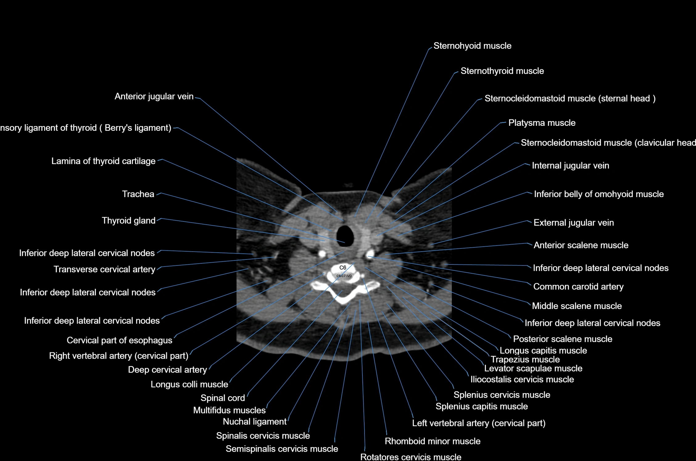 CT Neck axial cross sectional anatomy radiology image-img-00001-00047.webp